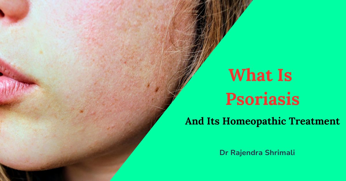 WHAT IS PSORIASIS